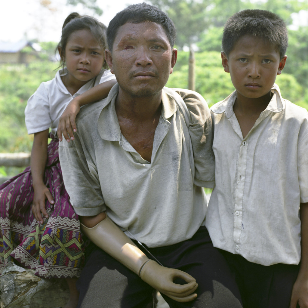 DTAR, LAOS: "One day in 2003 I took my two boys down to the river to go fishing. I found a cluster bomb in the water and picked it up. It went off in my hands and blew off my arms. Now we are getting poorer because I lost both my arms and I can’t work to support my family." [image credit: Cluster Munition Coalition]